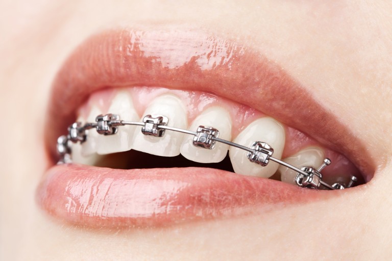 ¿Necesito brackets?